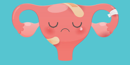 Animovaná ilustrace nemocné dělohy.
